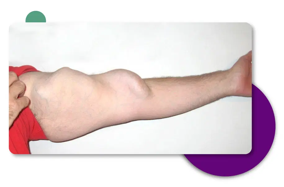 Arteriovenous Fistula Treatment in Gurgaon, Delhi - India
