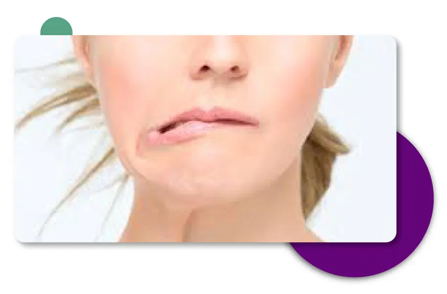 Bell's Palsy Treatment in Gurgaon, Delhi - India