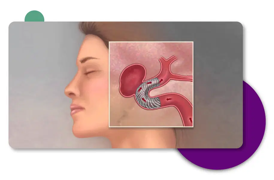 Brain Aneurysm Treatment in Gurgaon, Delhi- India