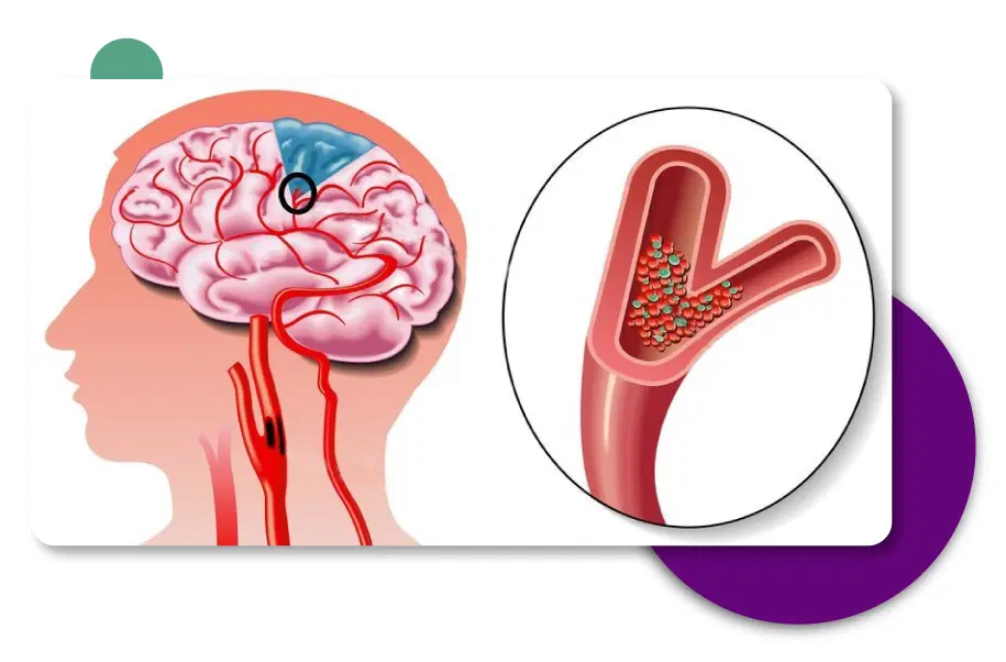 Brain Stroke Treatment in Gurgaon, Delhi - India