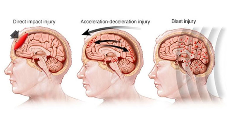 Head Injury doctor in Delhi