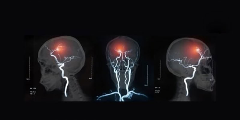Brain Hemorrhage doctor in Delhi