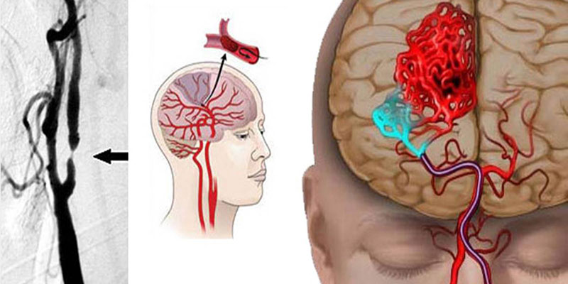 Brain Stroke Treatment in Gurgaon
