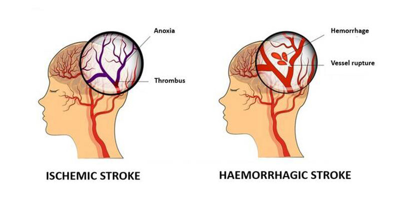 Best Brain Stroke Treatment Doctor in Gurgaon