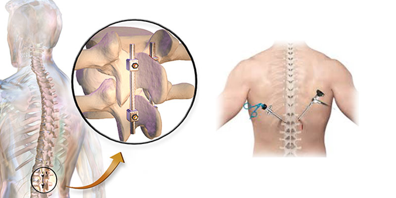 Minimally Invasive Spine Surgery