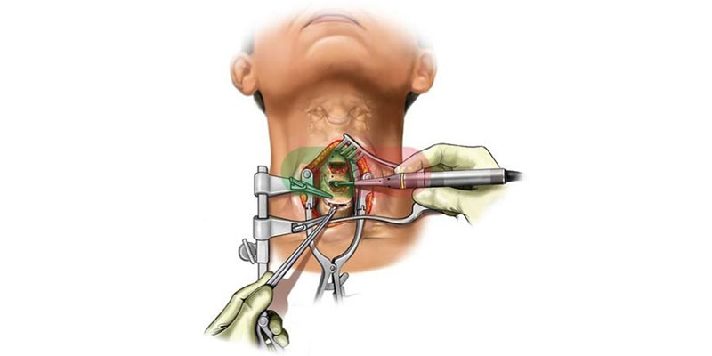Cervical Spine Surgeon in India