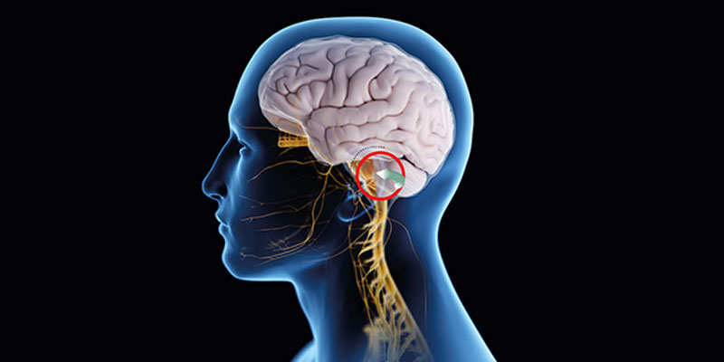 Trigeminal Neuralgia Treatment in Delhi
