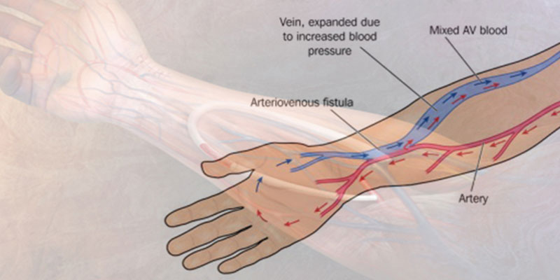 Arteriovenous Fistula Treatment Clinic in India