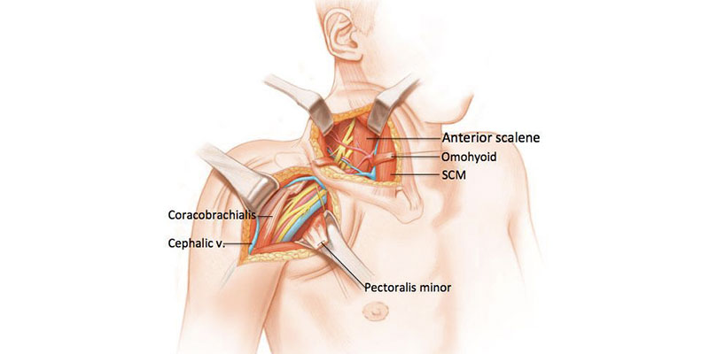 CSF Leak Treatment Clinic in Delhi
