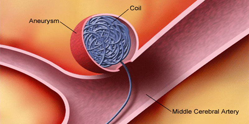 Brain Aneurysm doctor in Delhi