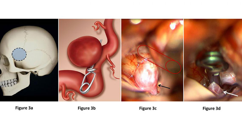 Brain Aneurysm Treatment Clinic in Delhi