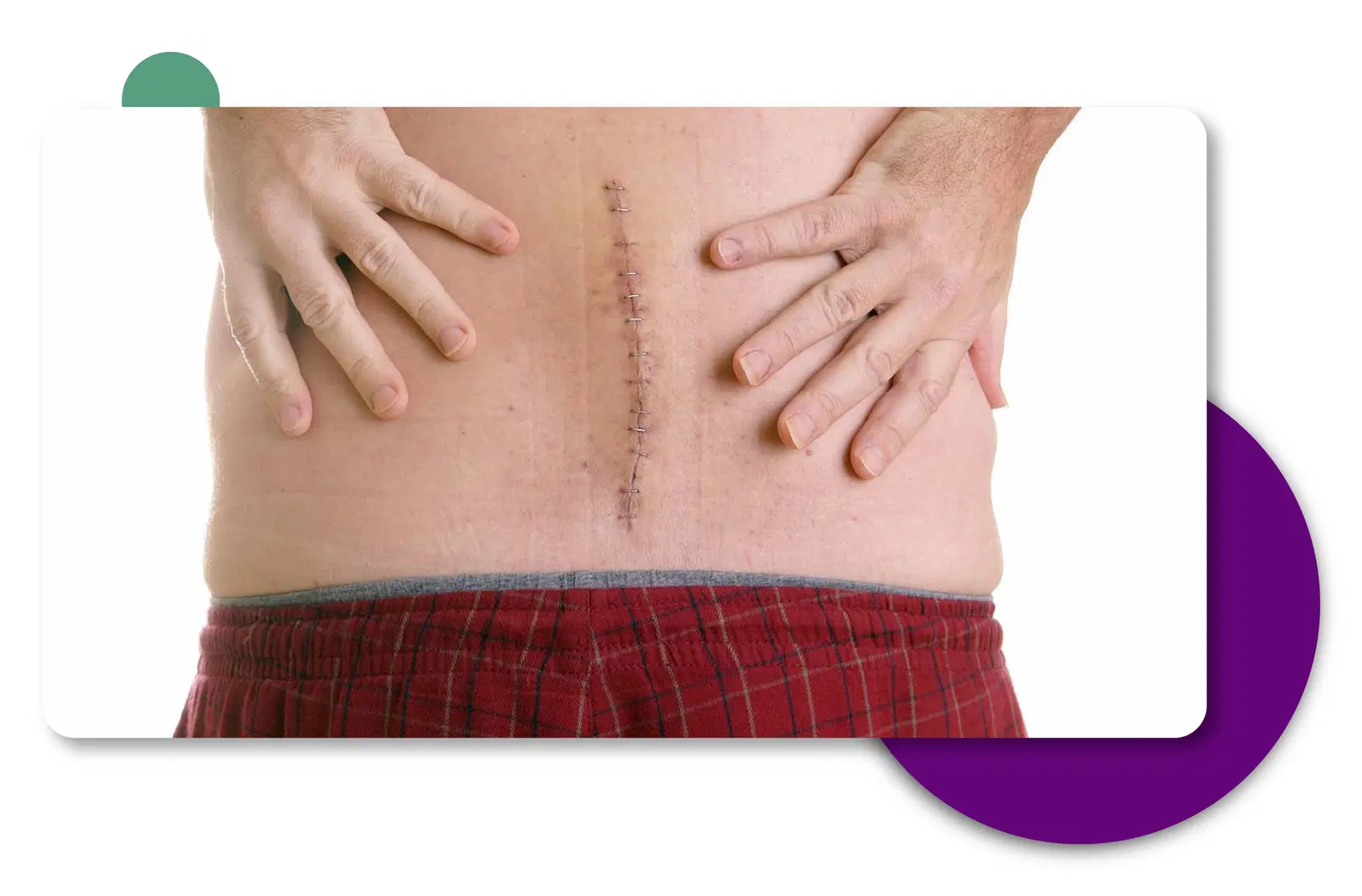 Lumbar Spine Surgery in Gurgaon, Delhi - India